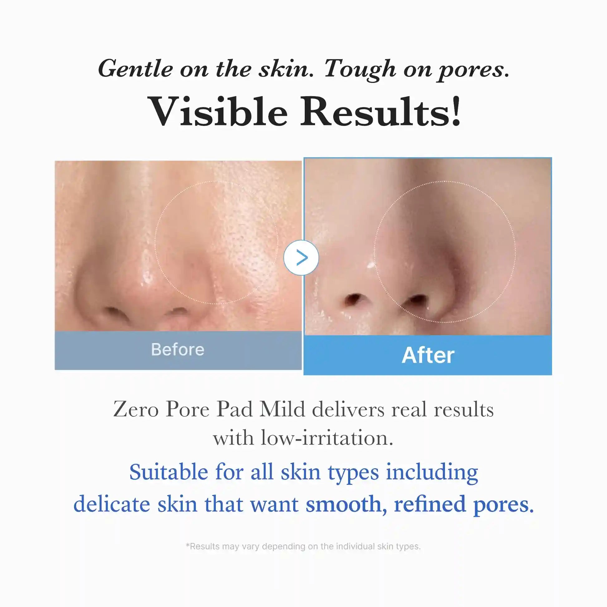 Fotografia comparativa de poros do nariz antes e depois do uso do Zero Pore Pad Mild
