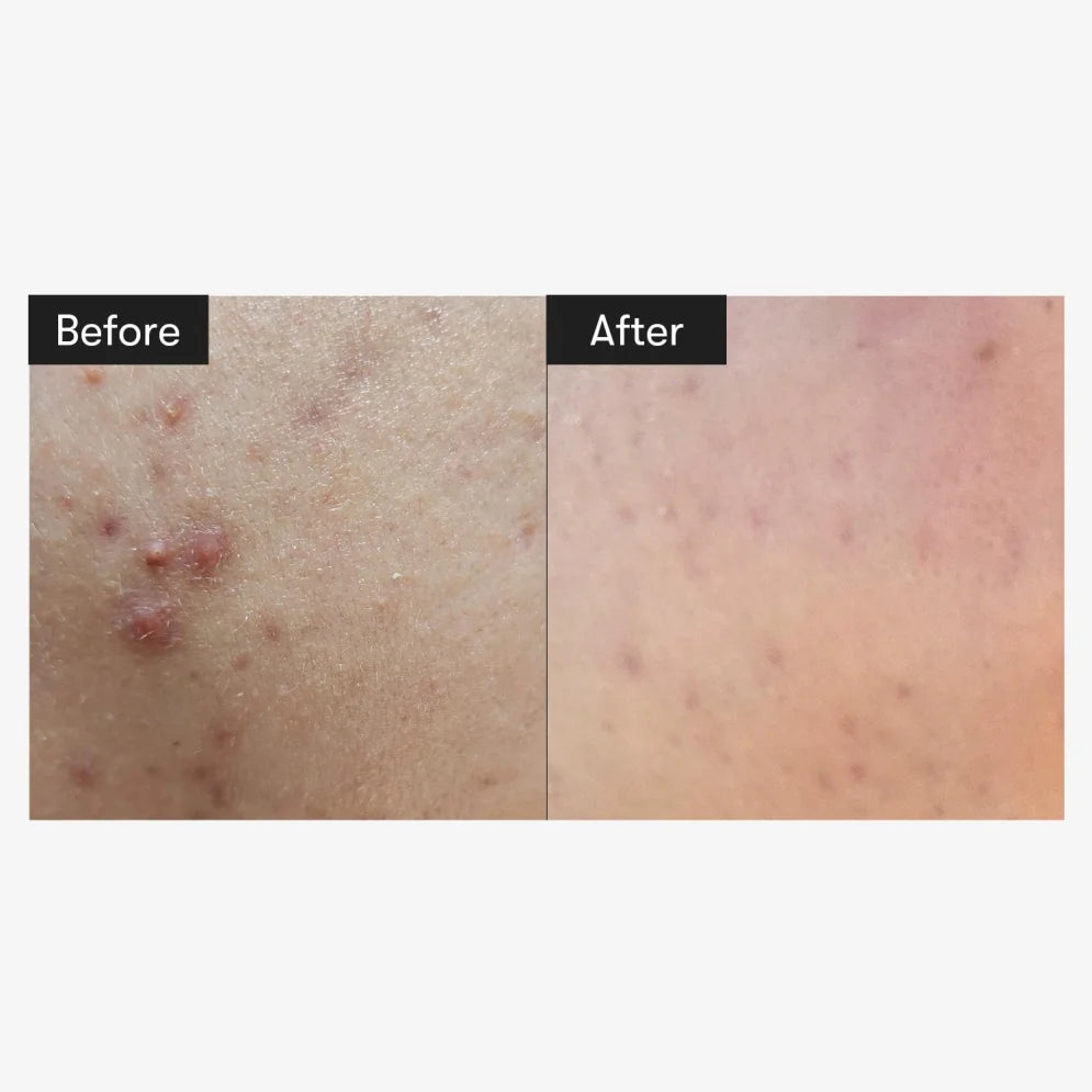 VT Cosmetics Reedle Shot 700 | Tratamento Semanal com Microagulhas — imagem 7
